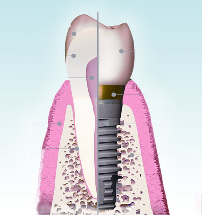 Implantologie - Polyclinique dentaire Européenne - Tours - Région Centre - Spécialités dentaires