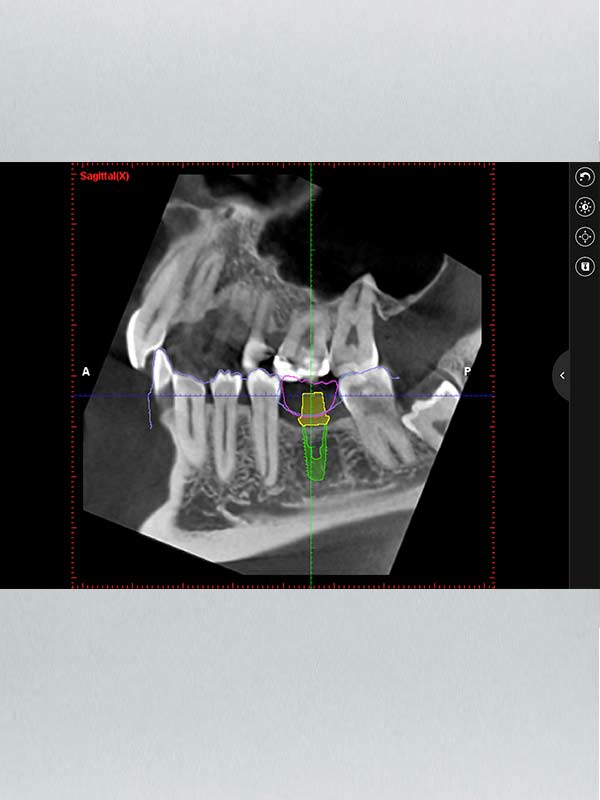 Radio 3D - planmeca - Polyclinique dentaire Européenne - Tours - Région Centre - Spécialités dentaires