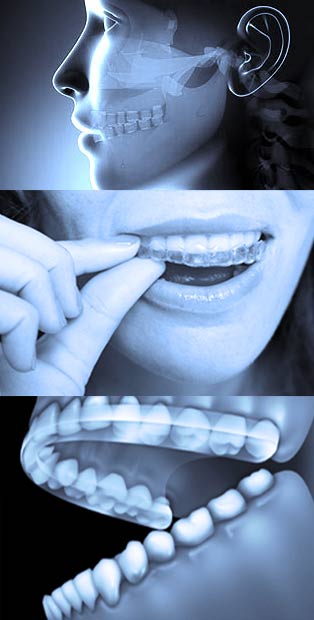 Bruxisme Occlusodontie - Polyclinique dentaire Européenne - Tours - Région Centre - Spécialités dentaires