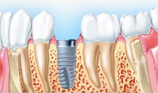 Implants dentaires à Tours - Polyclinique dentaire Européenne - Tours - Région Centre - Spécialités dentaires