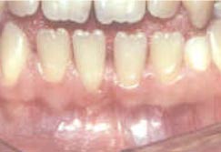 Origine des maladies parodontales - Polyclinique dentaire Européenne - Tours - Région Centre - Spécialités dentaires