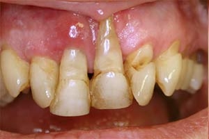 Saignement des gencives - Polyclinique dentaire Européenne - Tours - Région Centre - Spécialités dentaires