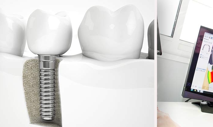 Les implants dentaires - Polyclinique dentaire Européenne - Tours - Région Centre - Spécialités dentaires