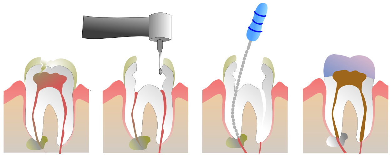 Endodontie - Polyclinique dentaire Européenne - Tours - Région Centre - Spécialités dentaires