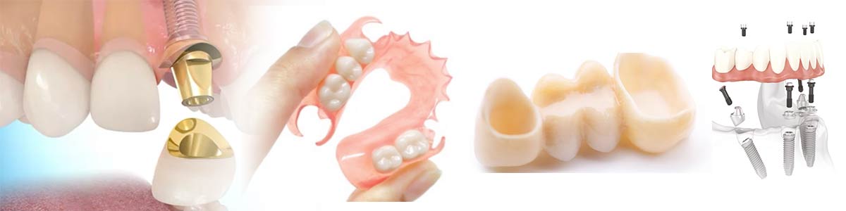Prothèses dentaires - Polyclinique dentaire Européenne Tours- Spécialités dentaires à Tours
