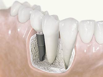 Greffe osseuse - Polyclinique dentaire Européenne Tours- Spécialités dentaires à Tours